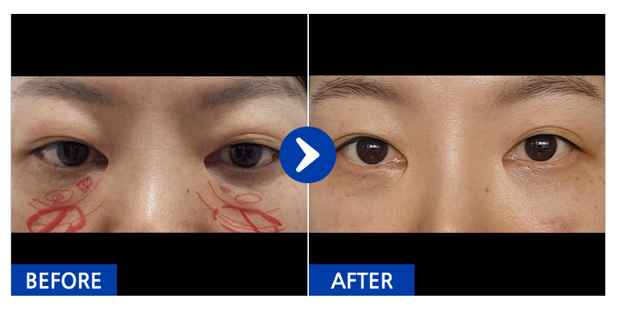 [강남언니] 눈밑지방재배치 / 1개월차/ 닉네임:유리알76