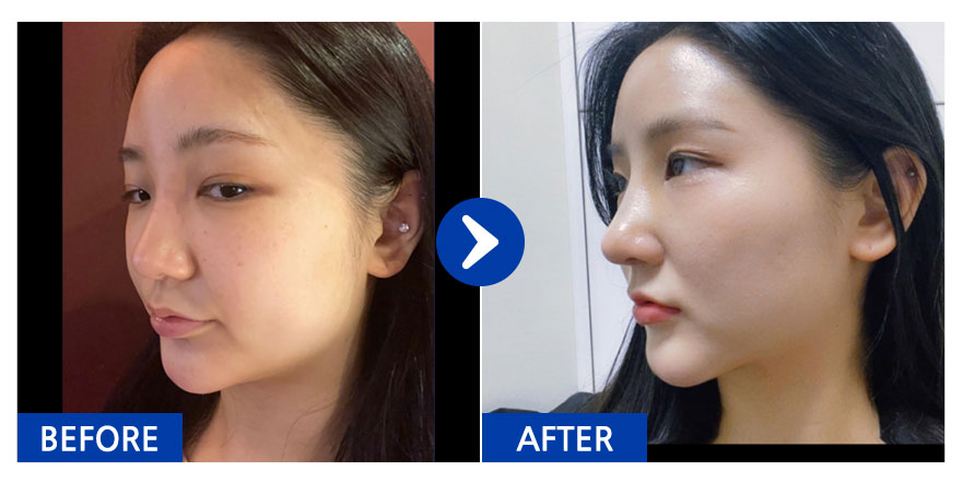 [바비톡] 코성형 / 2주차 / 닉네임 : 이뽀이쀼2