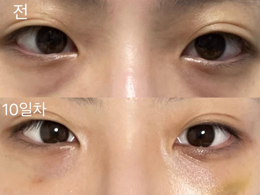[강남언니] 눈밑지방재배치 / 10일차 / 닉네임 :  suntree