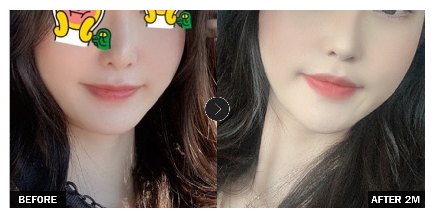 [강남언니 후기] 윤곽성형 두 달차 / 닉네임 : yrBang