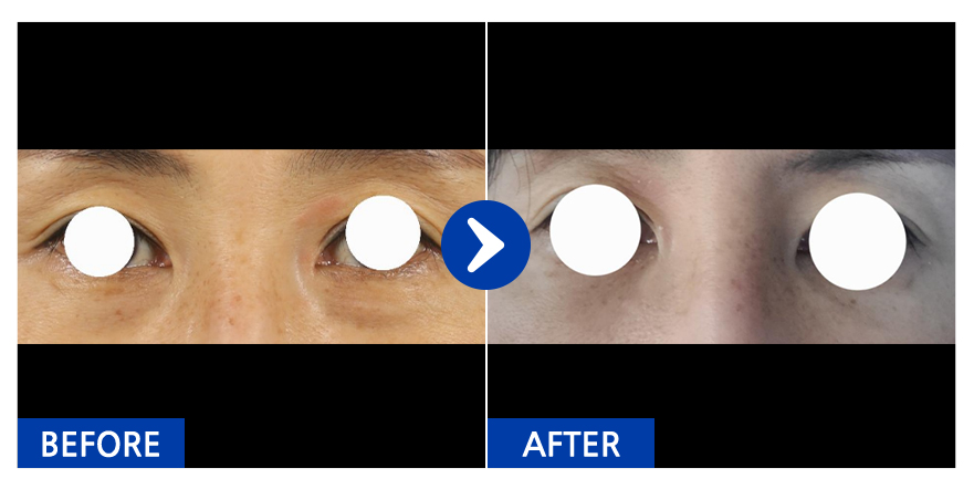 [강남언니] 눈지재 / １개월차/ 닉네임:차두리허벅지