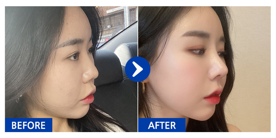 [강남언니] 코성형 / 1개월차 / 닉네임 : 드르르륵드르륵