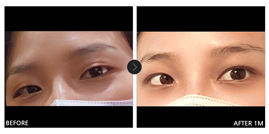 [강남언니 후기] 눈성형 한 달차 / 닉네임 : 피곤한아르마딜로