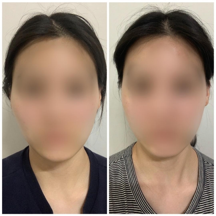 [강남언니 후기] 윤곽성형 한 달차 / 닉네임 : 도비메라