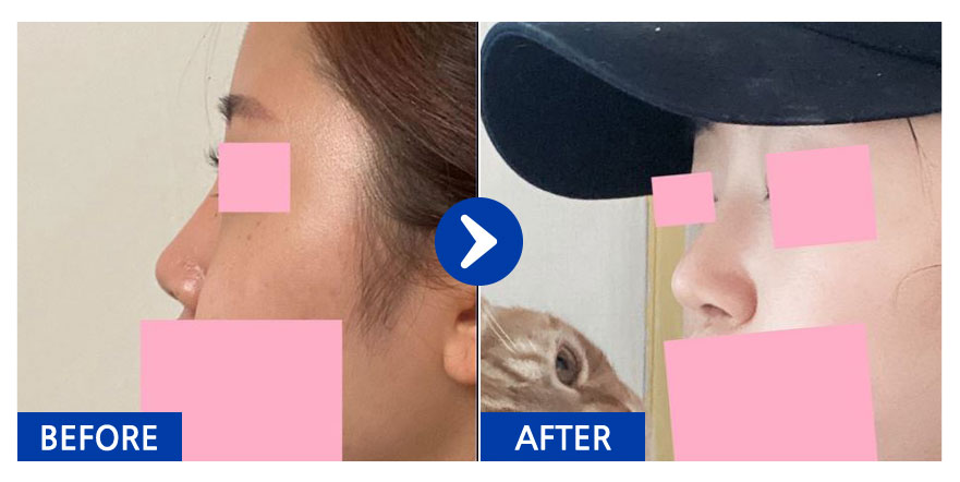 [강남언니] 코성형 / 2개월차/ 닉네임:젤리리리릴