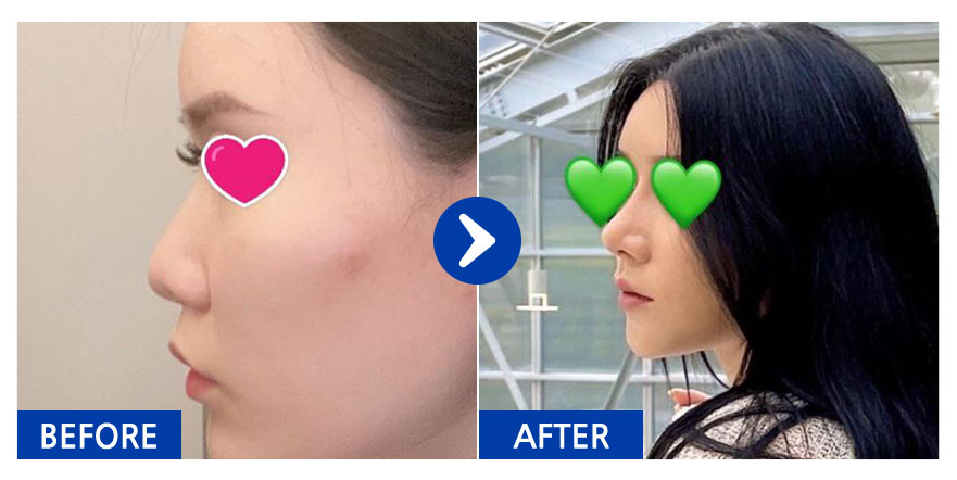 [바비톡] 코성형 / 3개월차/ 닉네임:닉네임뭐해에잇