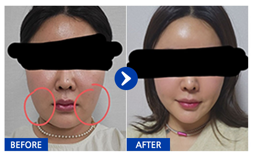 [강남언니] 지방흡입 / 2개월차/ 닉네임:꼬부기님