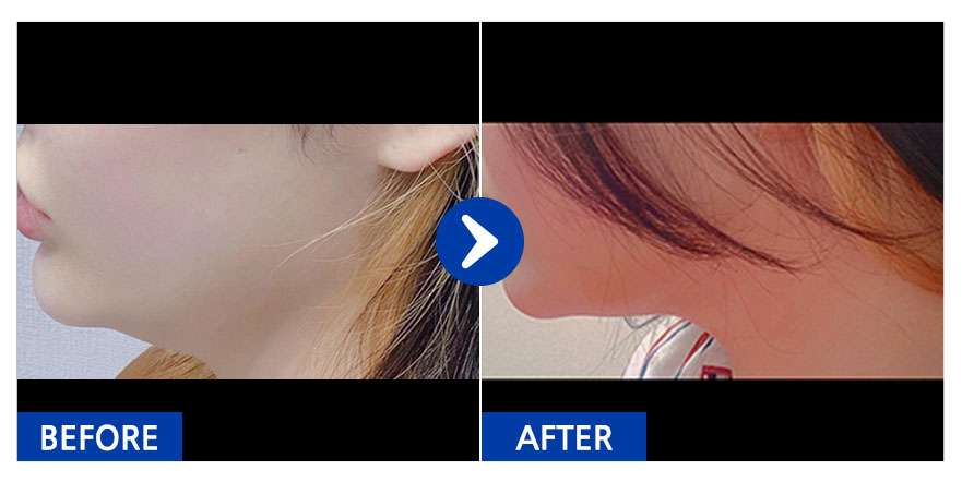 [강남언니] 지방흡입 / 닉네임:BYJ72