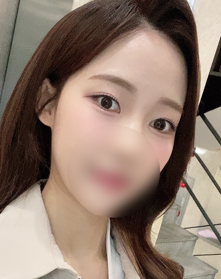 [眼睛] 짜냥 - 埋線雙眼皮（重做手術）