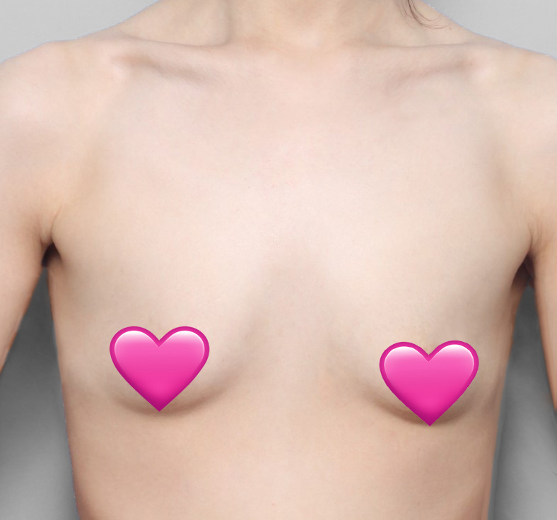 [隆胸] Smoothy - 胸部