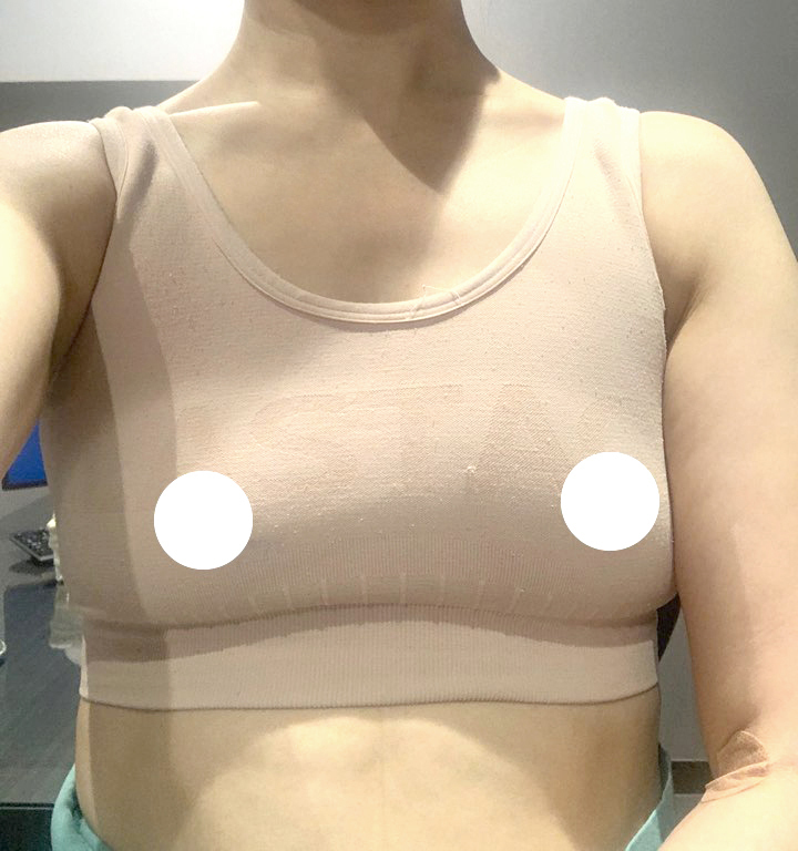 [隆胸] 玉順 - 隆胸