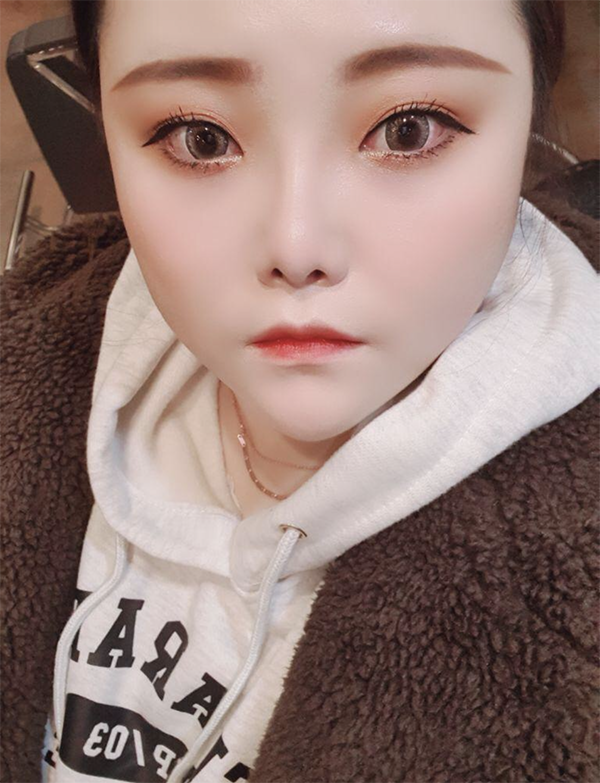 [微整形] lilyheejoo - 嘴唇