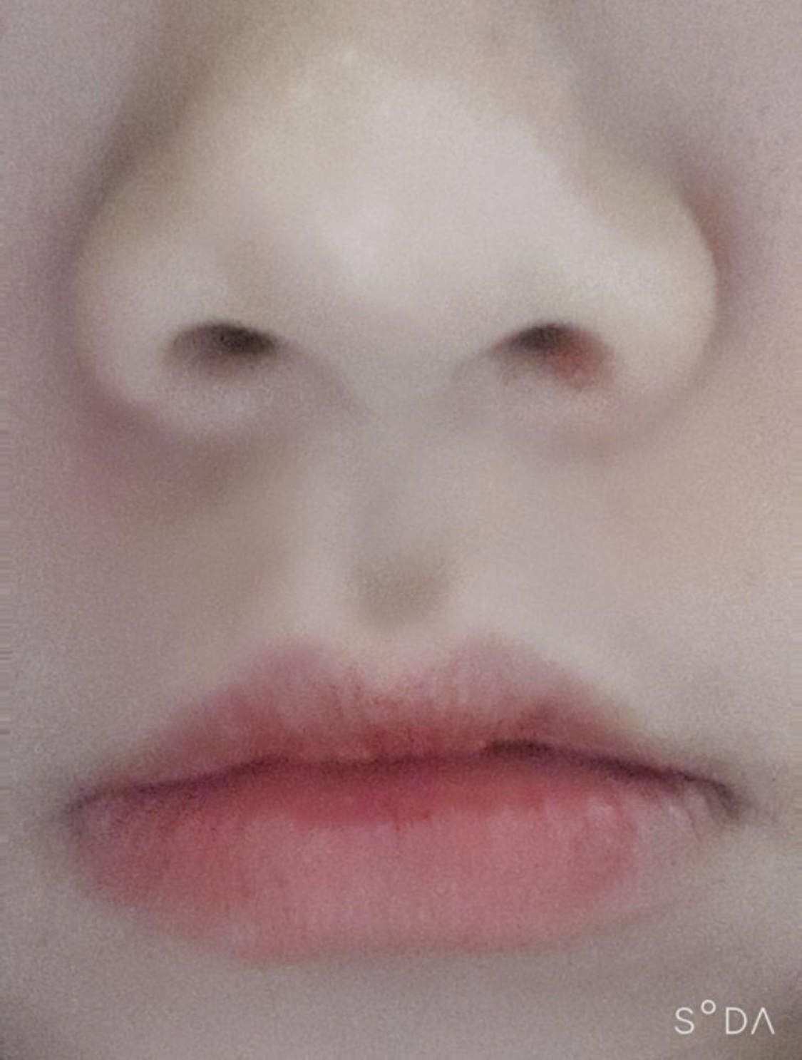 [微整形] ds0405 - 肉毒桿菌