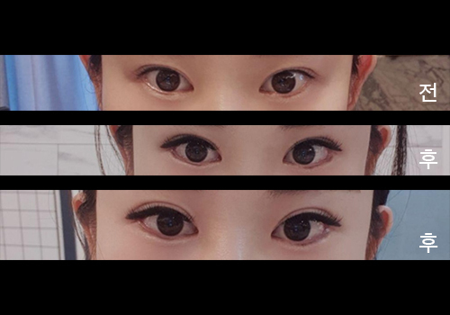 [眼睛] Seo Lovely 9999 - 下眼瞼下至, 後眼角切開