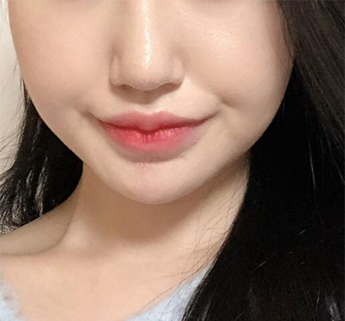 [皮膚] 嘰嘰嘰嘰嘰嘰 - 音波拉提、輪廓肉毒