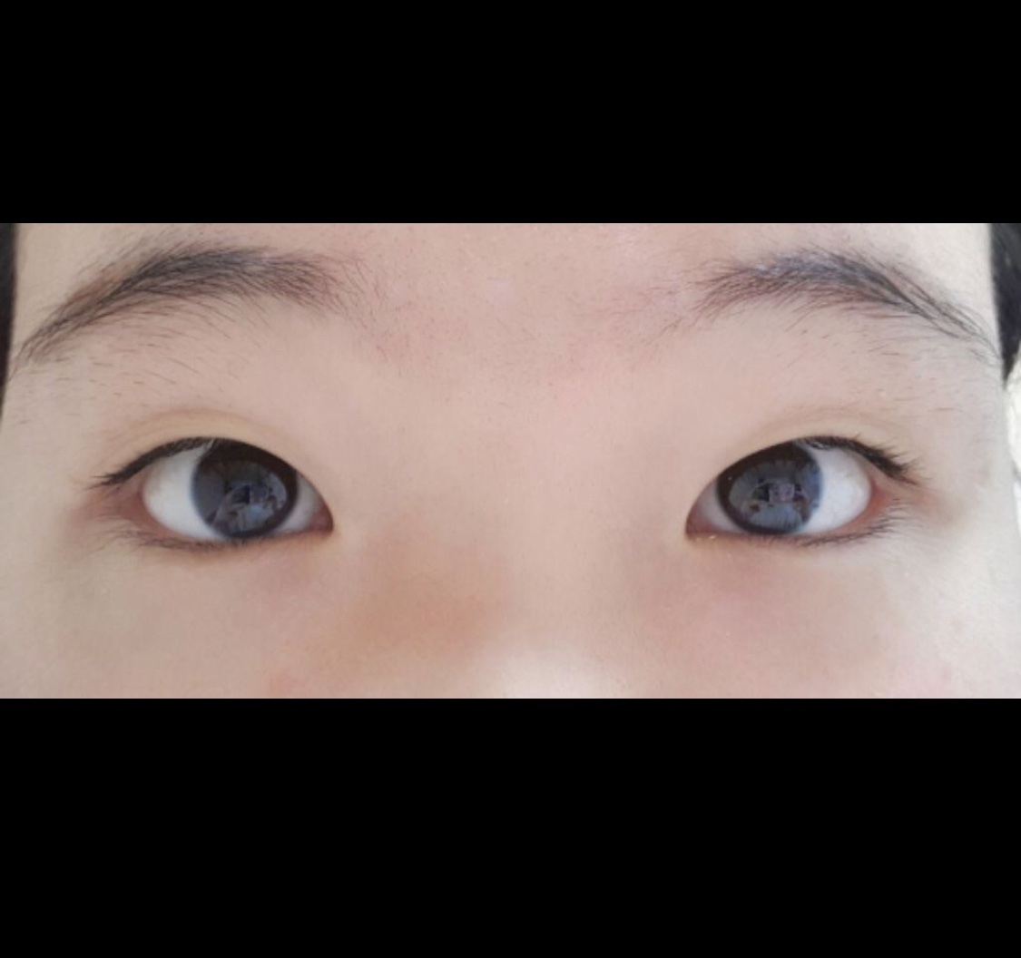 [眼睛] SSUYUYUN - 縫雙眼皮, 開眼頭