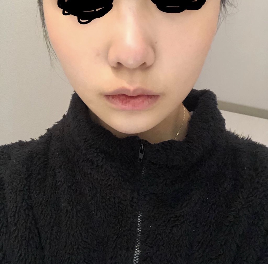 [鼻] mm9 - 縮鼻翼