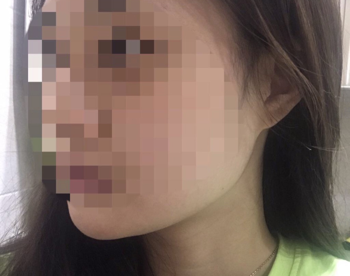 [微整] 妮娜的 - 溶脂針、拉提