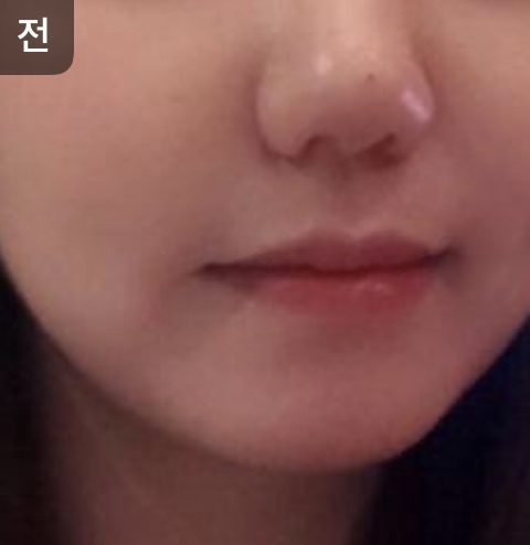 [皮膚] oy1004 - 拉提、水光注射