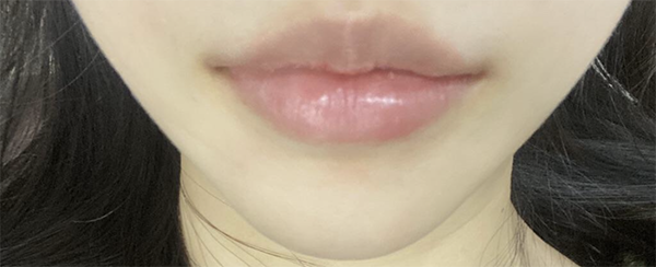 [微整形] 嘻嘻呵 - 嘴唇