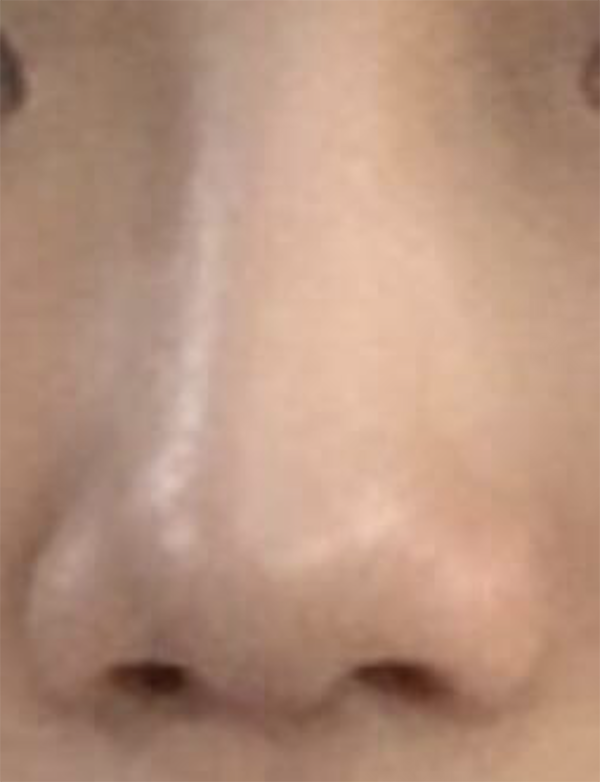 [微整形] dbwladl - 鼻子