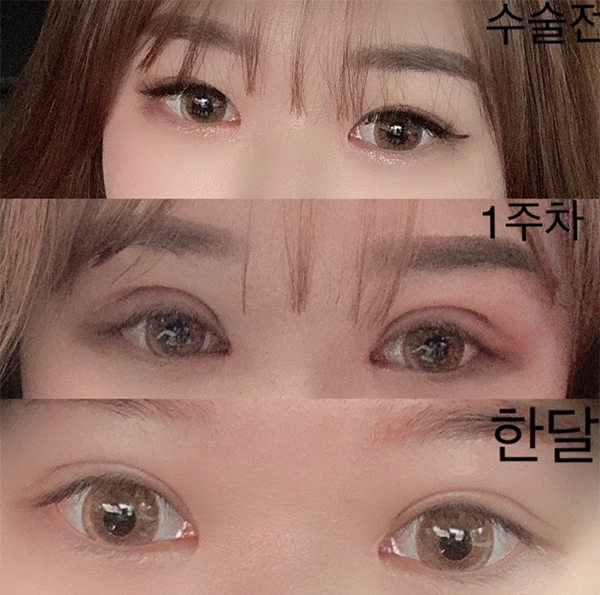 [眼睛] Rosicion - 開上眼角、眼型矯正、重修手術