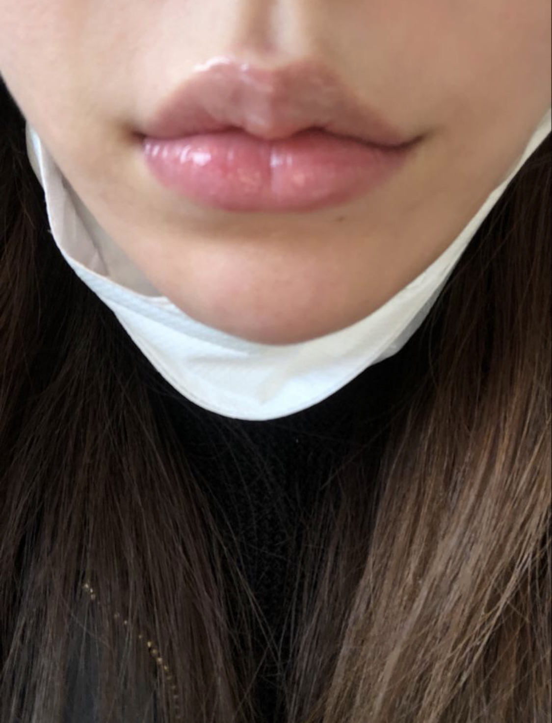 [微整形] vvkim - 填充劑