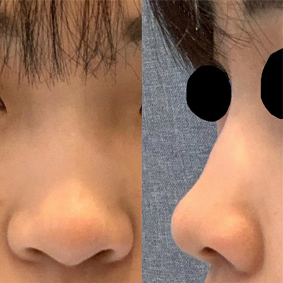 [鼻] 뀽뀽공 - 鼻