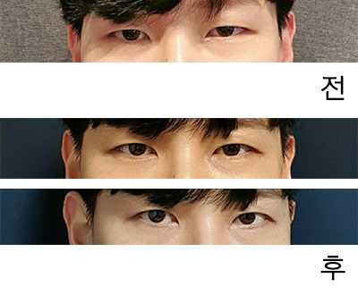 [眼睛] WDHH - 眼型矯正