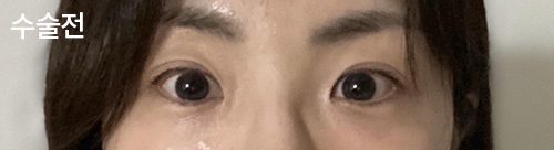 [眼睛] ㅈㅎㅊ - 眼睛