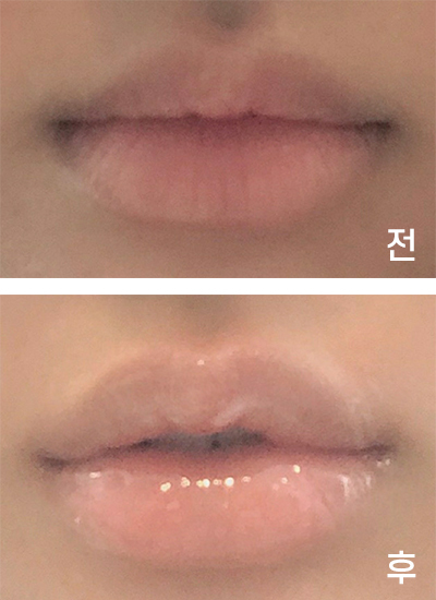 [微整形] ㅎ링ㅇ - 嘴角、嘴唇填充