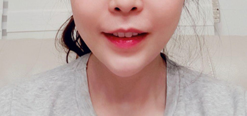 [皮膚] gus0311 - 填充劑、拉提