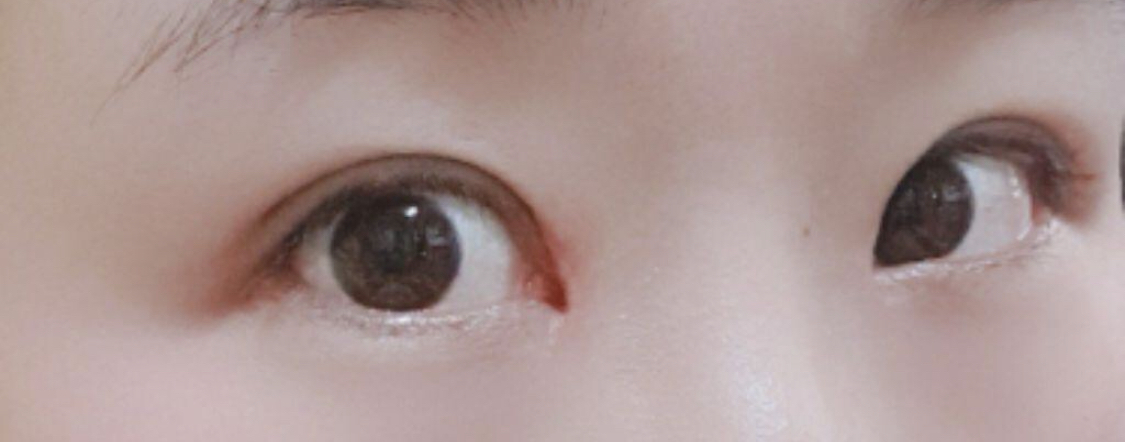 [眼睛] 핑구찐 - 眼型矯正、開眼頭/眼尾