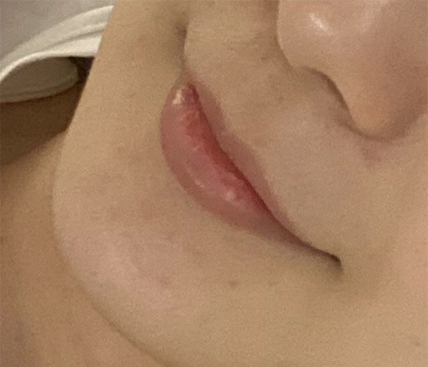 [微整形] 雲朵雲朵2 - 嘴唇