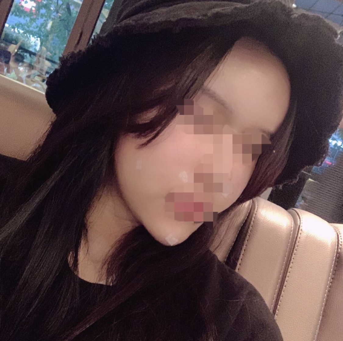 [抗衰老]江南좋아 - 脂肪移植