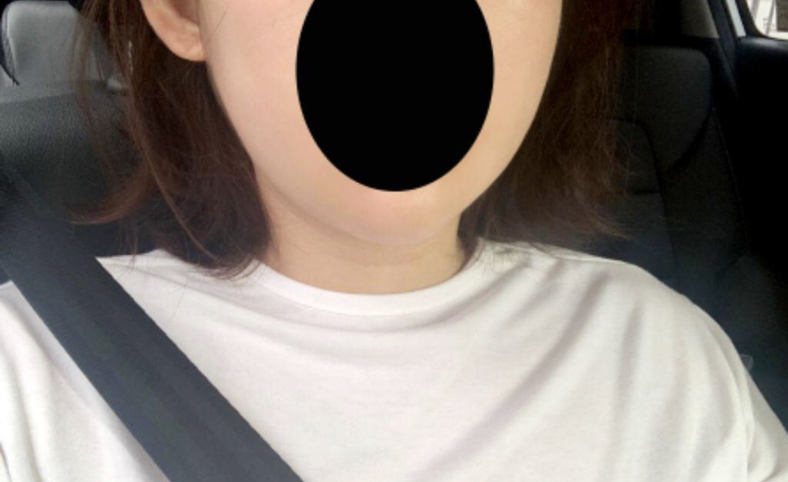 [抗衰老] Plain817 - 臉部脂肪抽吸