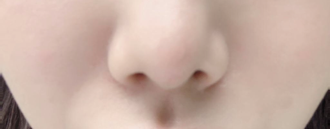 [抗衰老] 워니vv - 脂肪移植