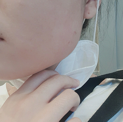 [微整形] seoul - 下顎肉毒桿菌