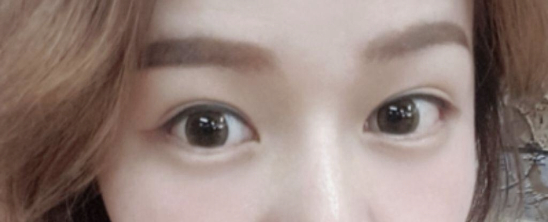 [眼睛] 想要變成理想的樣子 - 後眼角切開術、下眼瞼下至術