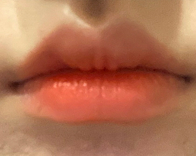 [微整形] Rapunzel@ - 嘴唇填充