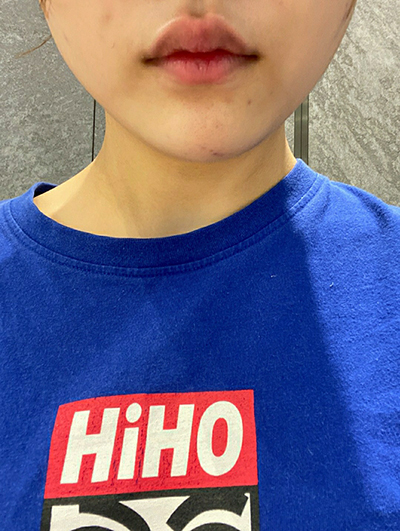 [微整形] 知允斯 - 肉毒桿菌瘦臉