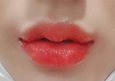 [微整形] 多熙 Ying - 填充劑