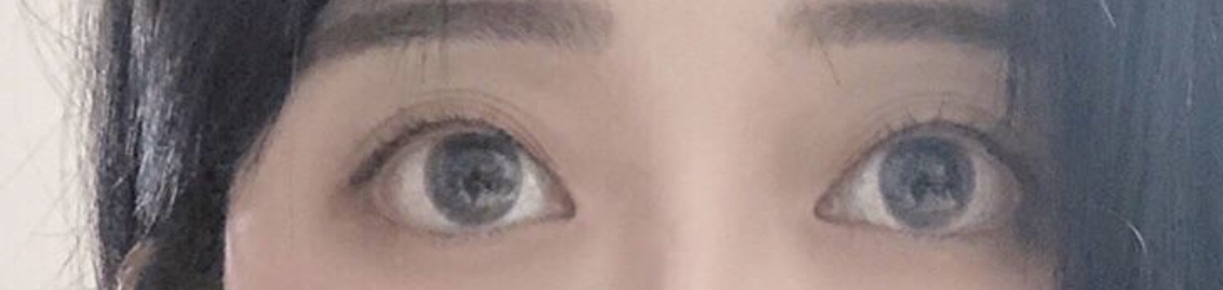 [眼睛] Hitwo - 眼型矯正, 縫雙眼皮