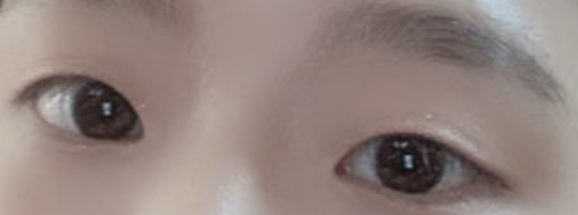 [眼睛] 李soo - 縫雙眼皮、開眼頭