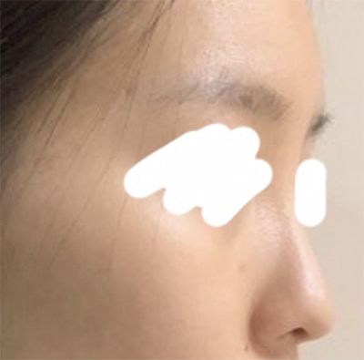 [鼻] Lupping Pong Pong - 鼻