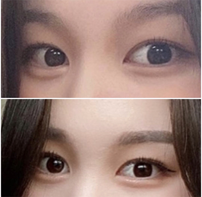 [眼睛] 연듀두 - 雙眼皮、開眼頭