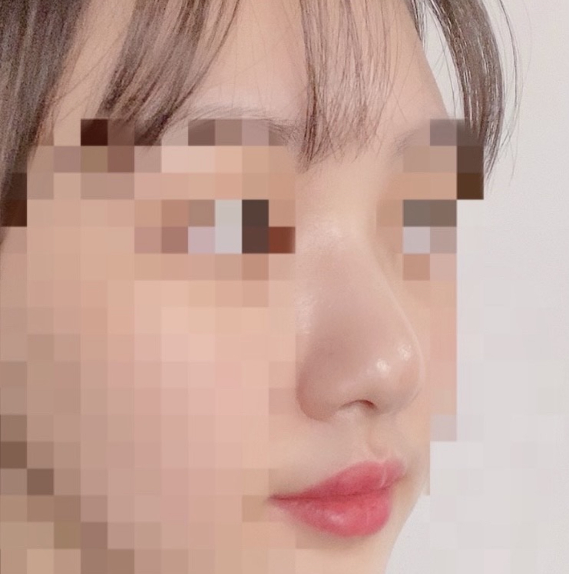 [鼻] Longdarangsa - 隆鼻手術