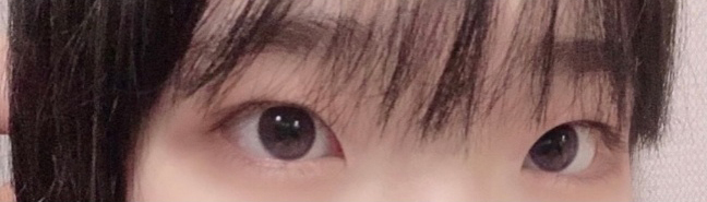 [眼部] 庫洛米s2 - 雙眼皮(切開), 開眼頭