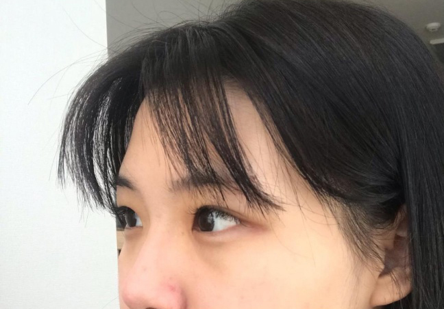 [眼睛] 嚶啊嚶 - 雙眼皮(自然黏連), 上眼瞼提拉