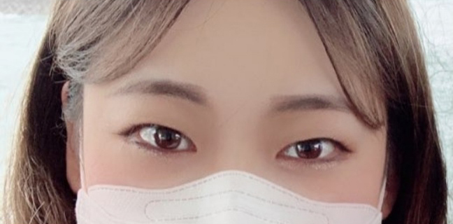 [眼睛] 多瓏美 - 雙眼皮(切開), 眼型矯正